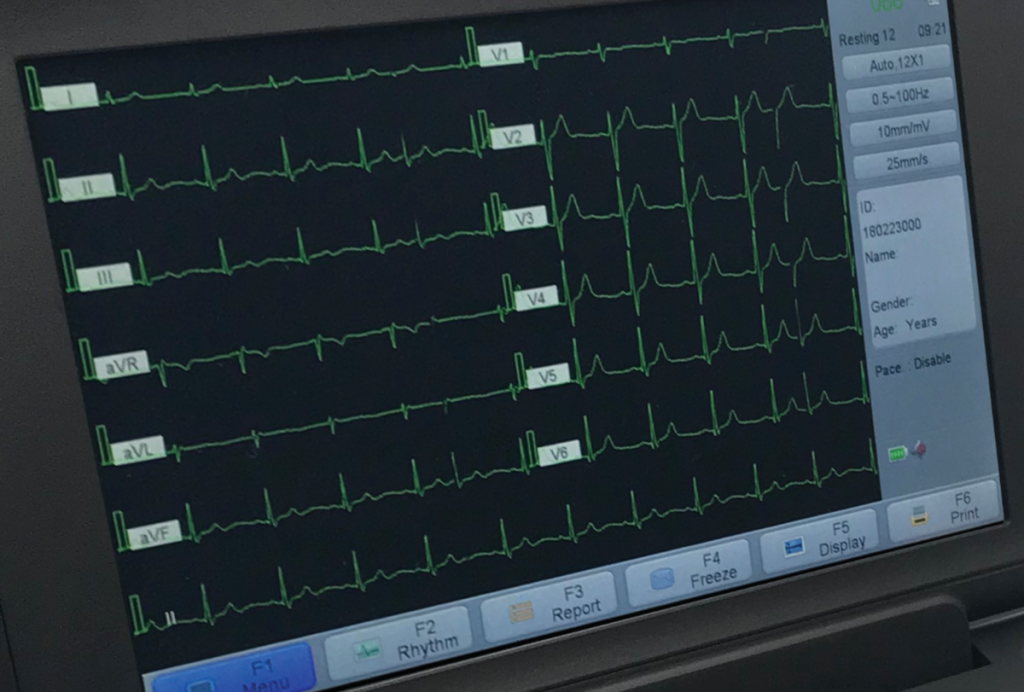 ekg machine screen with waveform