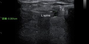 Vertebrae - L Spine