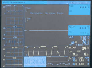 capnography wave form phases