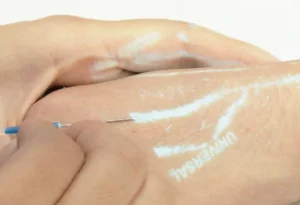 vein finder on hand