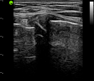 Knee - Spur & Bulging Meniscus